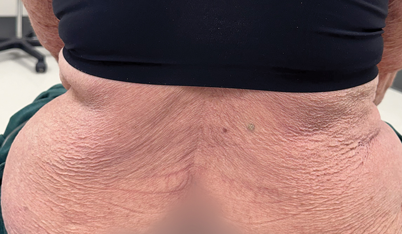 Imagen real del cuero cabelludo de un paciente con psoriasis en placas de moderada a severa después de 16 semanas de tomar SOTYKTU®.