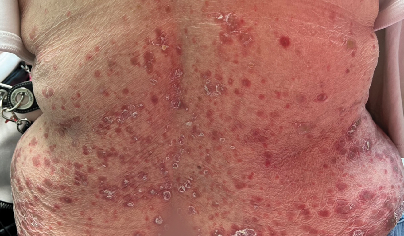 magen real de un paciente con psoriasis en placas de moderada a severa en el cuero cabelludo el día 0 de SOTYKTU®.