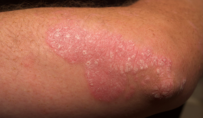 Imagen real de un paciente con psoriasis en placas de moderada a severa en el brazo el día 0 de SOTYKTU®.