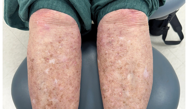 Imagen real de las piernas de un paciente con psoriasis en placas de moderada a severa después de 24 semanas de tomar SOTYKTU®.