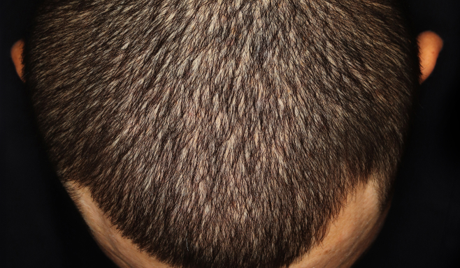 Imagen real del cuero cabelludo de un paciente con psoriasis en placas de moderada a severa después de 16 semanas de tomar SOTYKTU®.