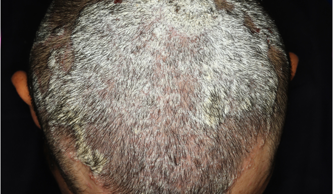 magen real de un paciente con psoriasis en placas de moderada a severa en el cuero cabelludo el día 0 de SOTYKTU®.